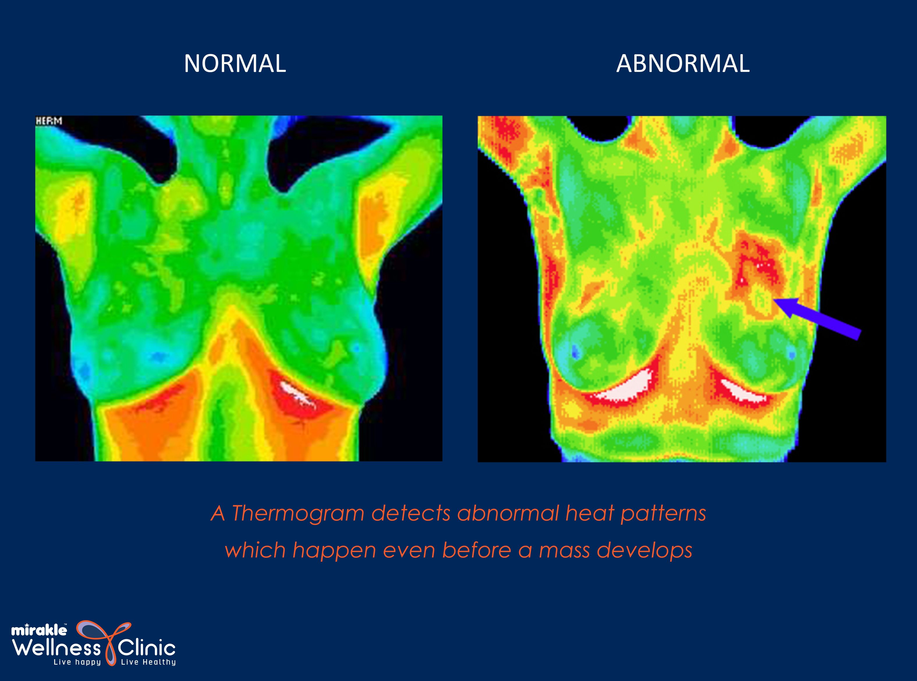 Breast Thermography in India